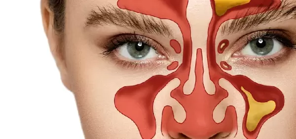 Sinüzit Belirtileri Nelerdir? Nasıl Geçer?
